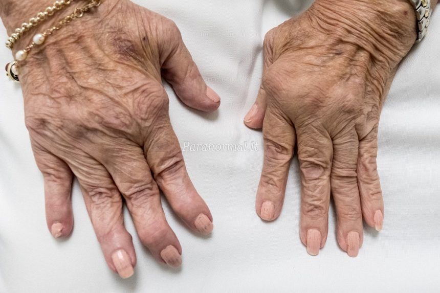artritas artritas piršto rankos kurios tepalas