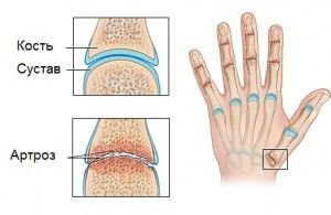 artritas artrozė skausmas sąnariuose reumatinės sąnarių gydymo