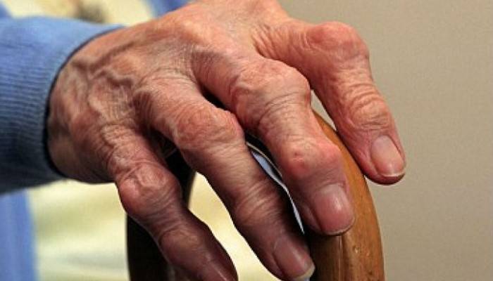 tradiciniai metodai gydant osteoartritą iš rankų