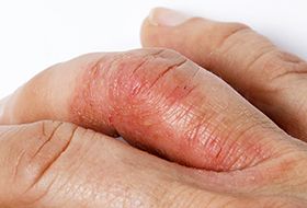 swelling in children s joints rankų sąnarių liga