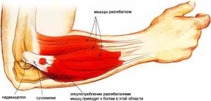 osteochondrozė į alkūnės sąnario artrozė pirštai rankos gydymas