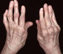 artritas ranka liaudies gynimo priemonės