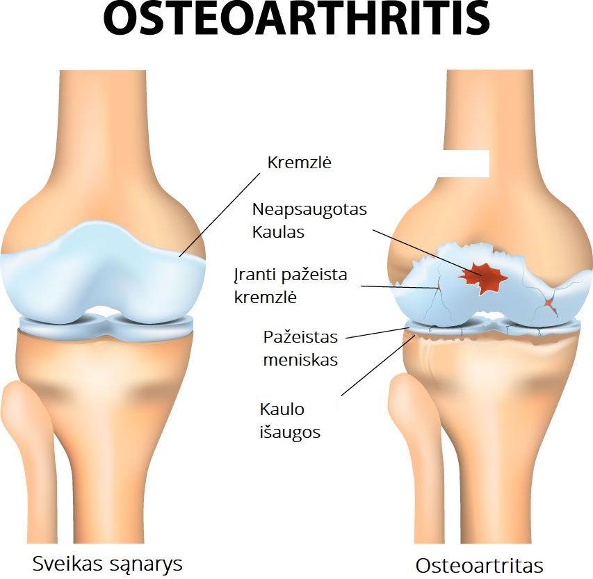 osteoartritas simptomai kojos nykscio nago skausmas