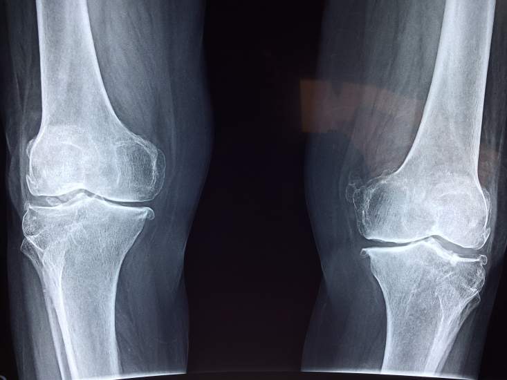 medicina artrosis pėdų gydymas skausmas stiprinimas sąnariai