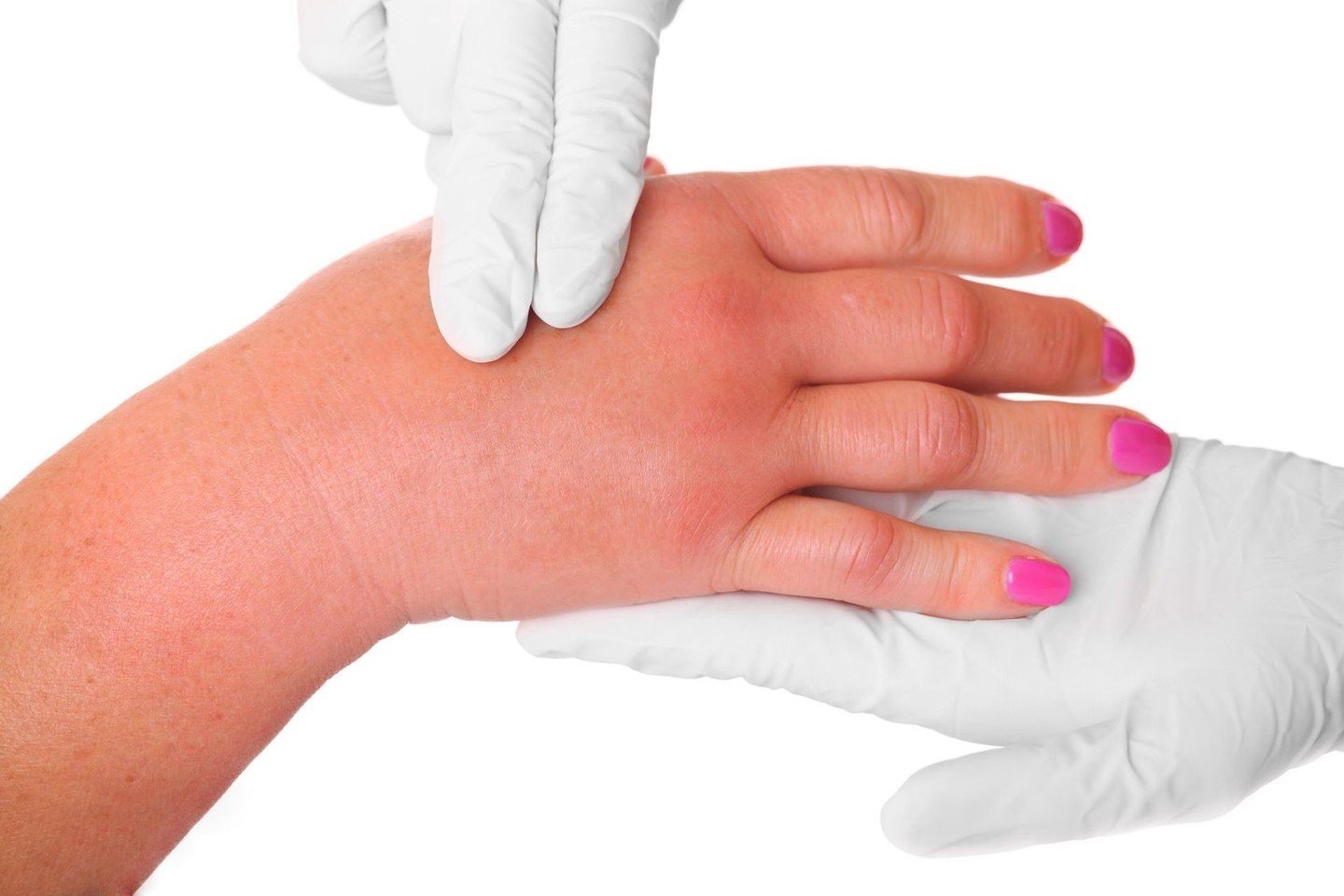 gydymas artrito namie ant rankų pirštų gerklės alkūnės sąnario gydymas