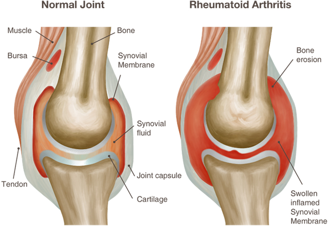 kur lėtinis artritas yra traktuojami taškas osteochondrozės gale