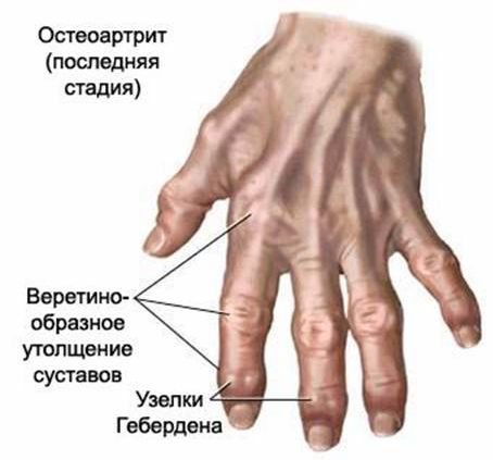priežastis dėl kurios į sąnarį atskleidimo traumos reumatoidinis artritas ranka priežastis