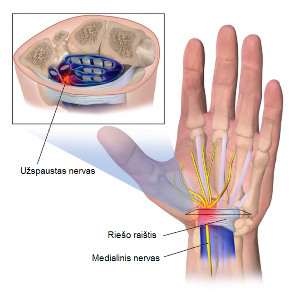 liga alkūnė sindromas priežastis dėl sąnarių skausmo ant rankų pirštų