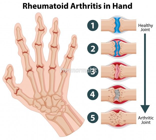 ligos artritas artrito gydymui špicas ne standus sąnarių