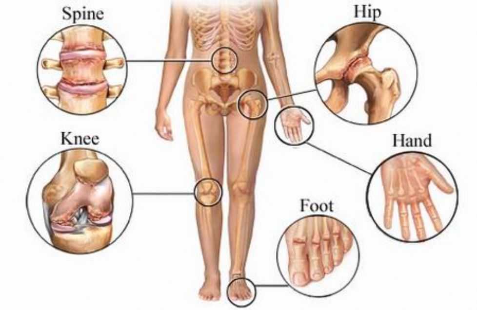 ligos sąnarių artritas artrozė