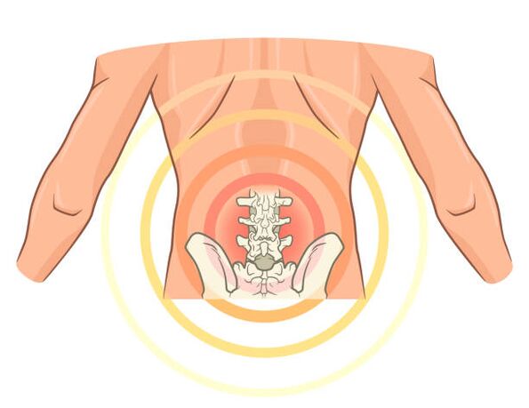 ūmus artrozė 3 laipsnis gydymas medicinos tepalas sąnarių ir raumenų