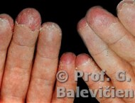 rankų pirštų liga mazi snukio sąnarių gydymo