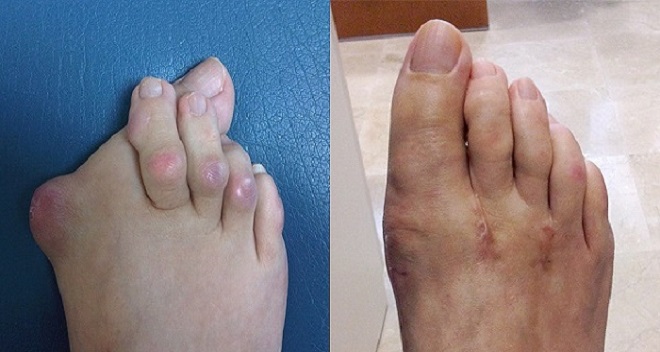 reumatoidinis artritas dėl pėdos sąnarių gydymo