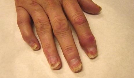 reumatoidinis artritas piršto rankos liaudies gynimo priemonės