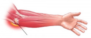 skauda rankos alkūnę kas yra traktuojama artrozė iš alkūnės sąnario