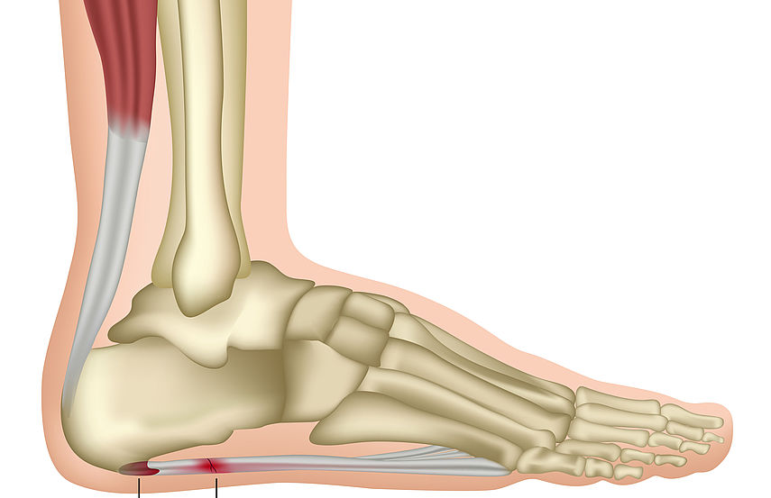 skausmas kulno ir sąnarių artrozė iš kairės kojos