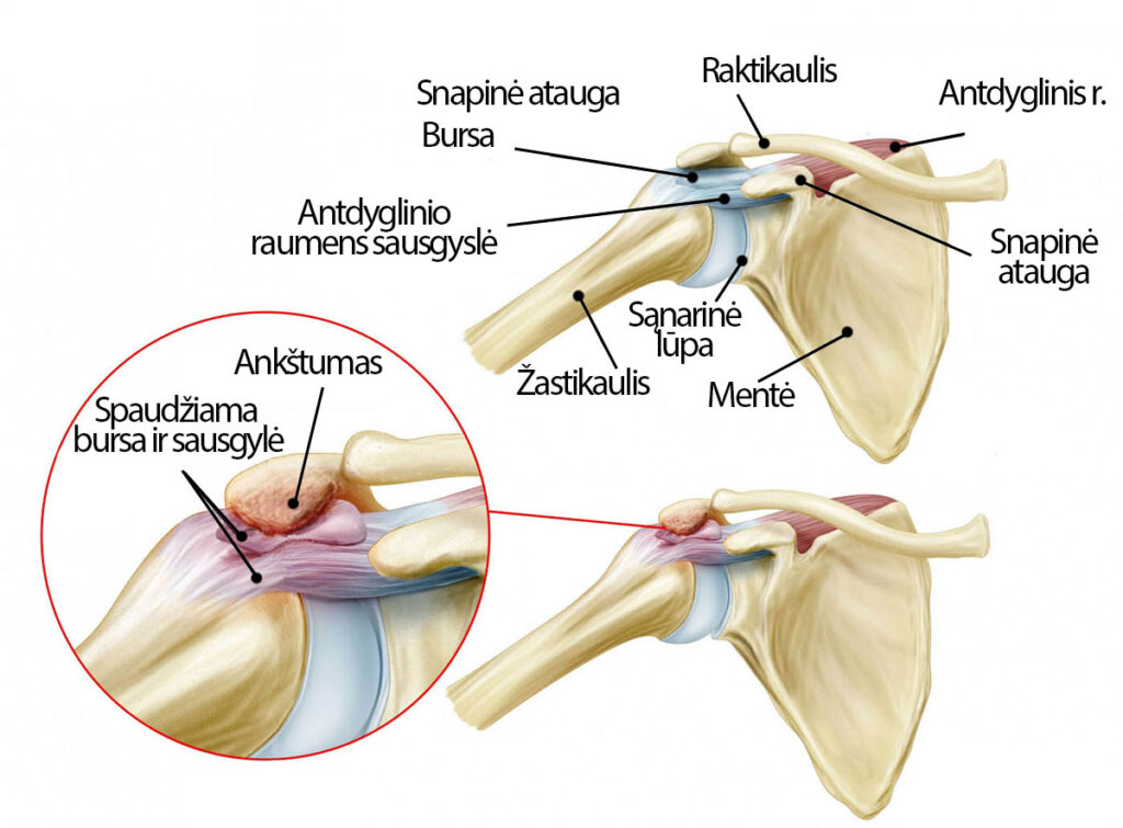 artrozė sustav hip artrozė iš šepetėliu ir pėdų sąnarius