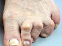 swollen painful toe joints tasabed skausmas skausmas