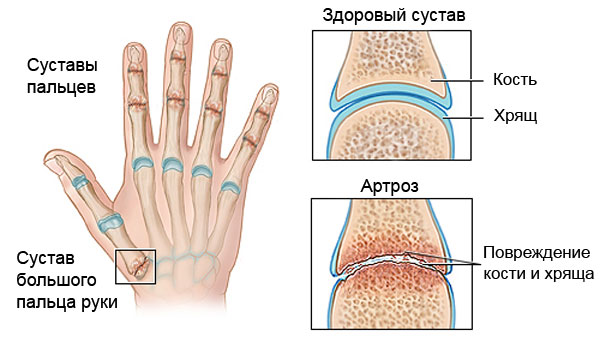 artrozės jungtys šepetys rankinis gydymas įrankiai iš sąnarių skausmas ir radikulitui