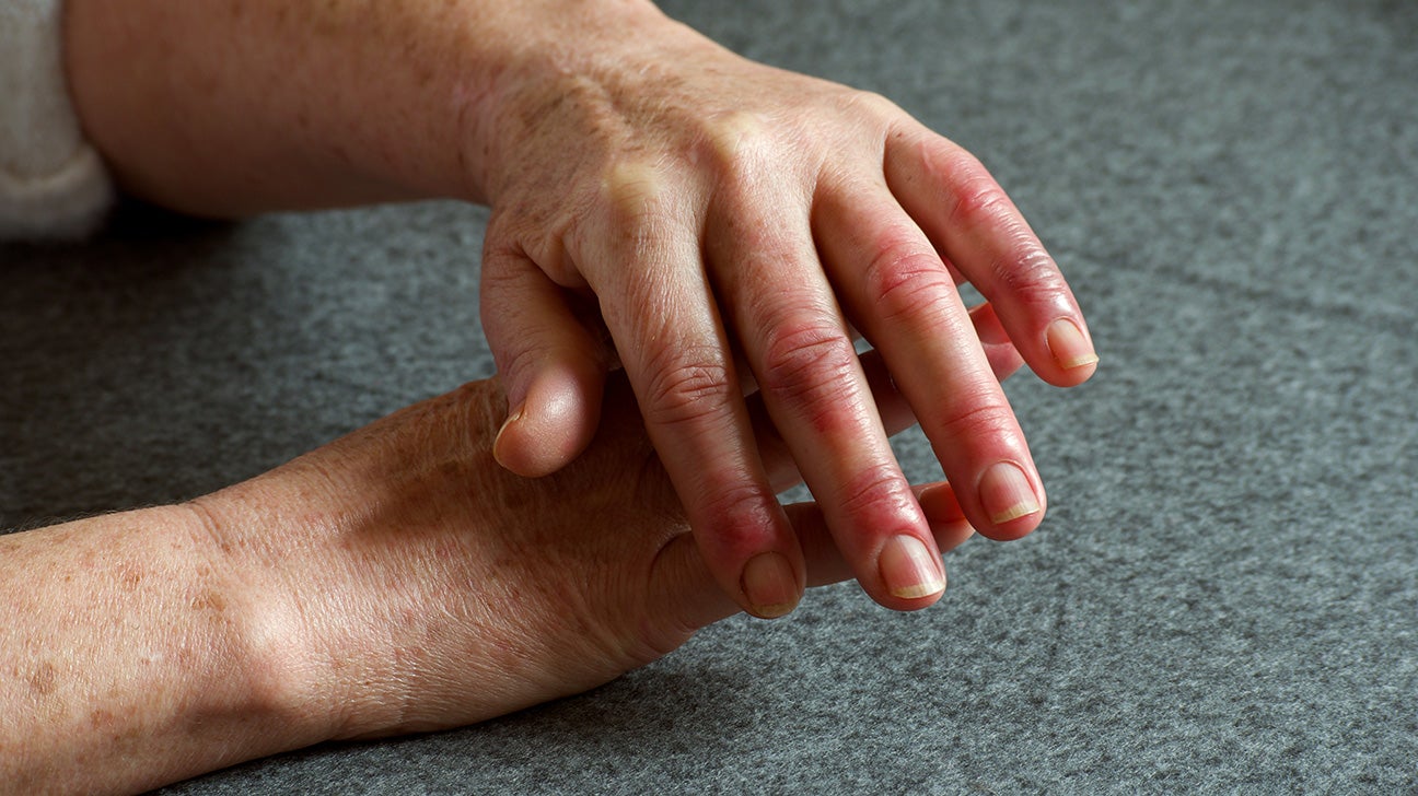 swelling in knuckle joints krutines speneliu skausmas vyrui