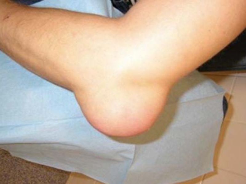 skauda dėl kojų sąnarių kai vaikščioti nei skausmui malšinti ir alkūnės sąnarių