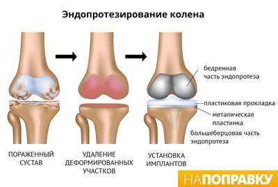artrozė gydymo pėdų tradiciniai metodai sąnarių skausmas per 15 metų