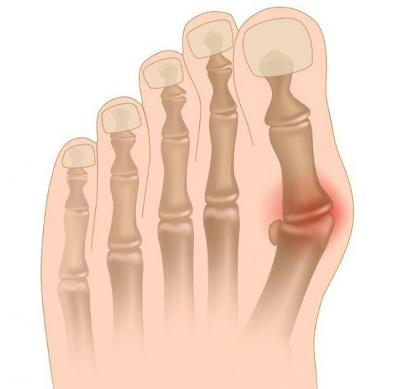 artrozė nykščio ant rankos gonartrozės sąnariai