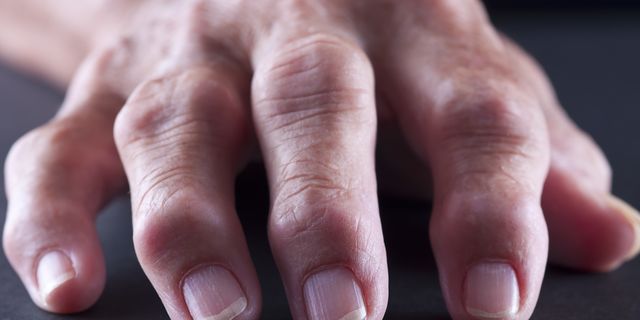 swelling in knuckle joints sustav patinimas nepatenka