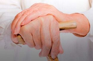 ką daryti su pirštu artritas