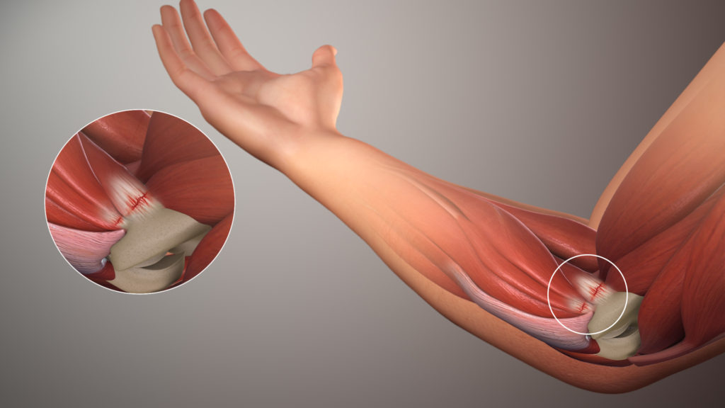 liaudies metodai artrozės nykščio gydymo raumenų skausmas brazy bendra