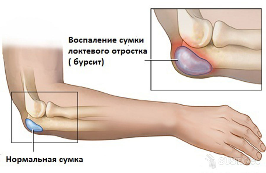tradicinių gydymo metodai artrito alkūnės pakuotės tepalas į artrito pirštais