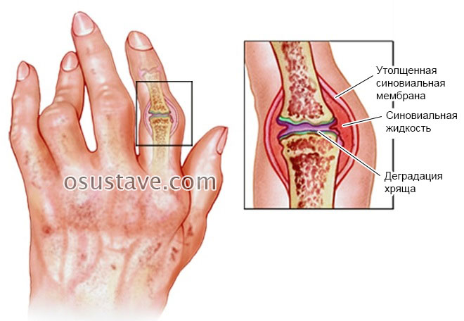 ligos kaulų ir sąnarių studijoje gydymo artrozės problema