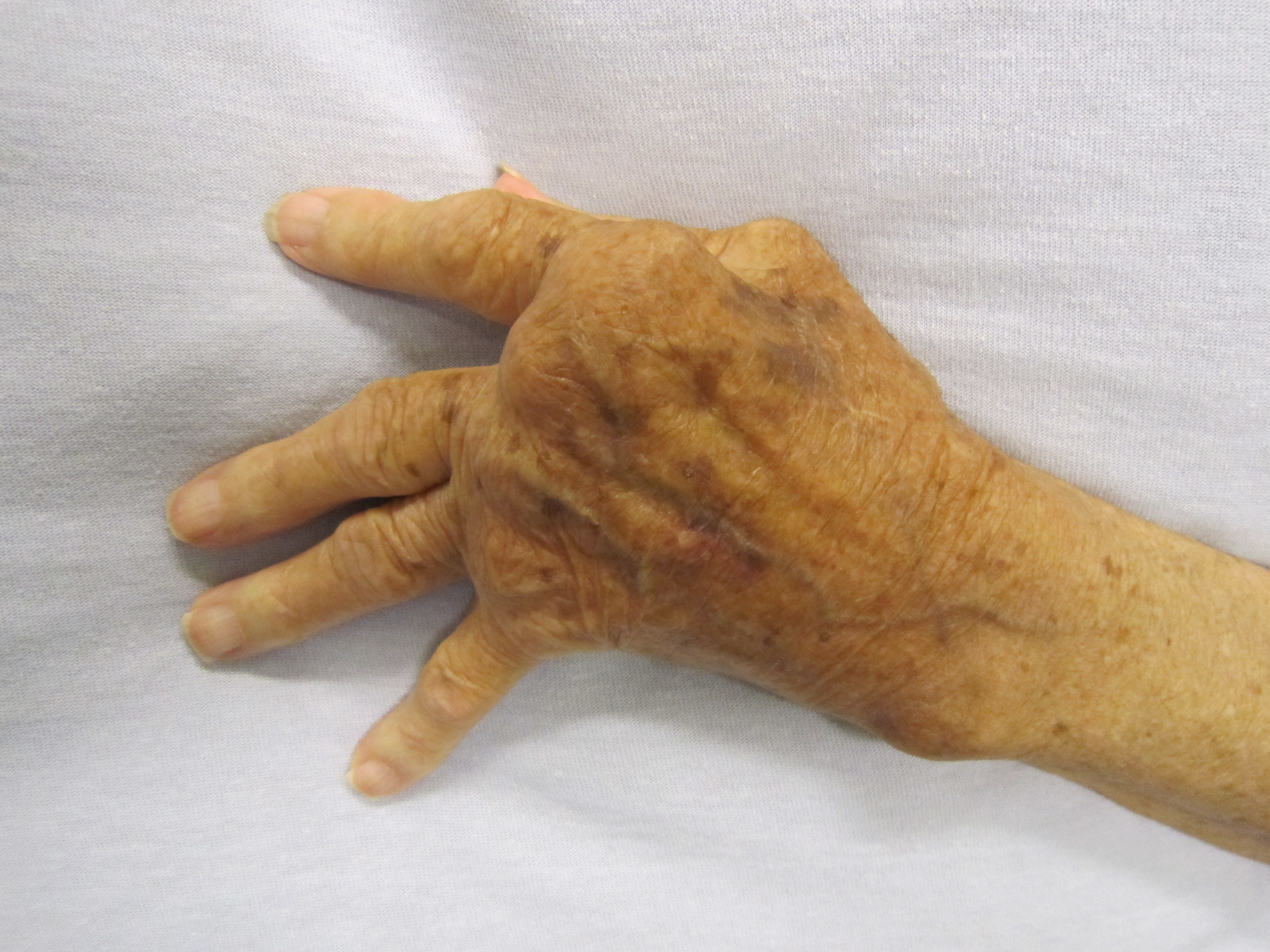 reumatoidinis artritas wiki ant rankos piršto sąnarių kūgio gydymas liaudies gynimo