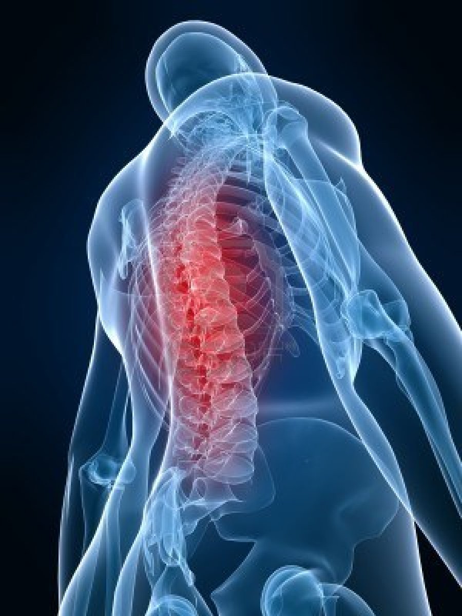 gydymas artrozė steroidų skauda bendrą petį iš nugaros