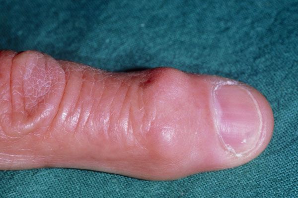 swelling in knuckle joints liaudies gynimo priemonės nuo skausmo sąnariuose