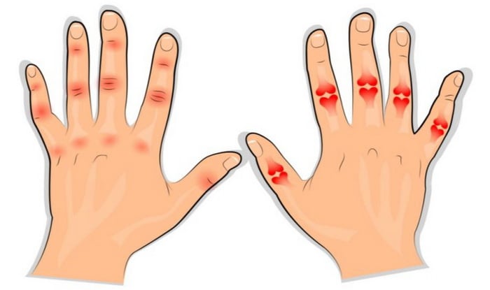 jei sąnariai kenkia ant pirštų gydymo gydymo artritas sąnarių šepečių rankos