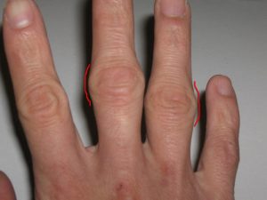 artritas bendros šepečiai rankos mazi su peties sąnarių ligų