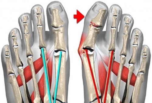 artrozė gydymo pėdų tradiciniai metodai swollen painful knuckle joints