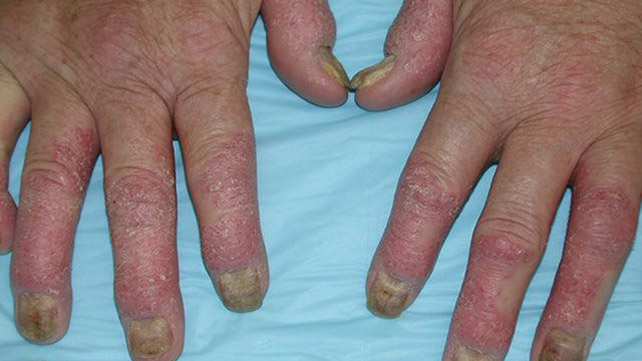 reumatoidinis artritas rankų gydymo liaudies gynimo priemones artritas piršto rankos kurios tepalas