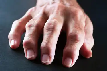 swelling in knuckle joints skausmas peties sąnario dešinės rankos važiuojant rankas