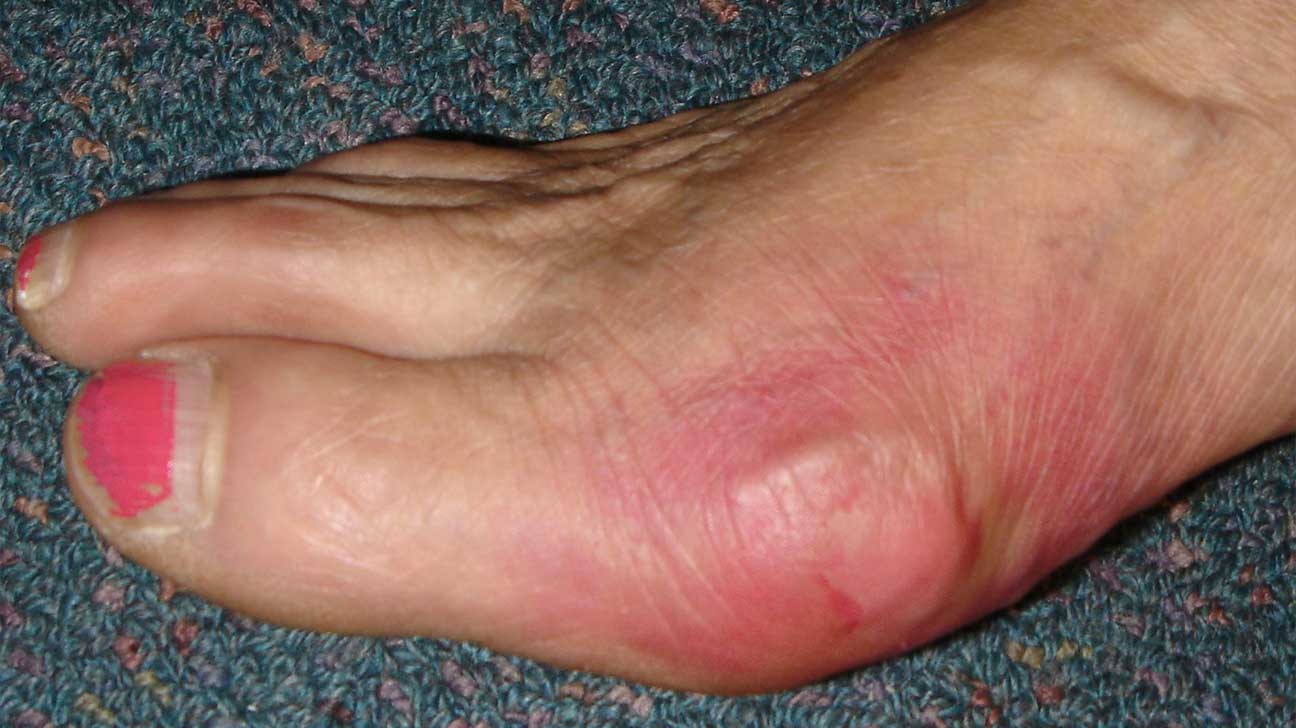 swelling painful joints in fingers and toes